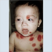 Radio Naf 99.2 fm জলবসন্ত (Chickenpox) সংক্রামক রোগ নিয়ে সচেতনতামুলক বার্তা :